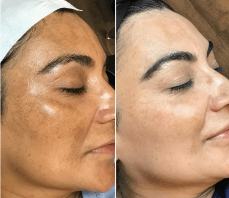 Melasma + Colágeno